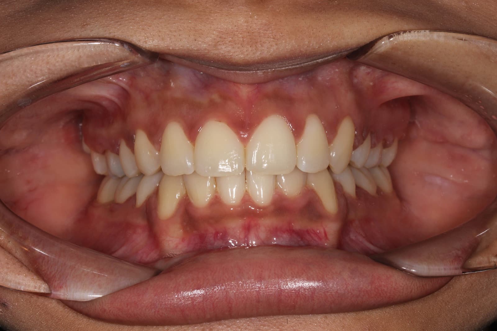 Chavez — after orthodontic treatment at Linea