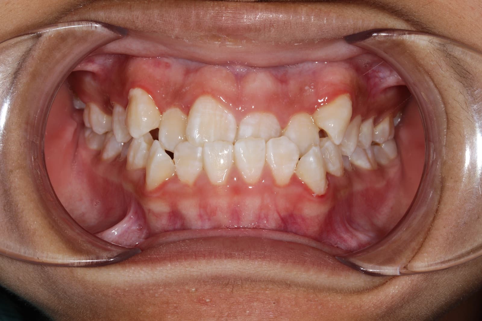 Linda — before orthodontic treatment at Linea