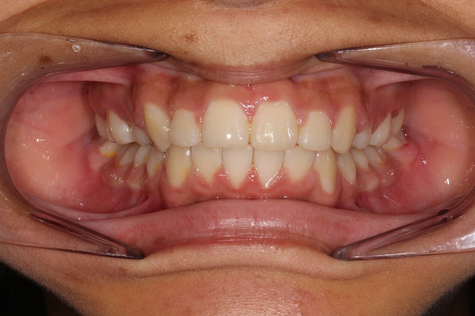 Susan — after orthodontic treatment at Linea