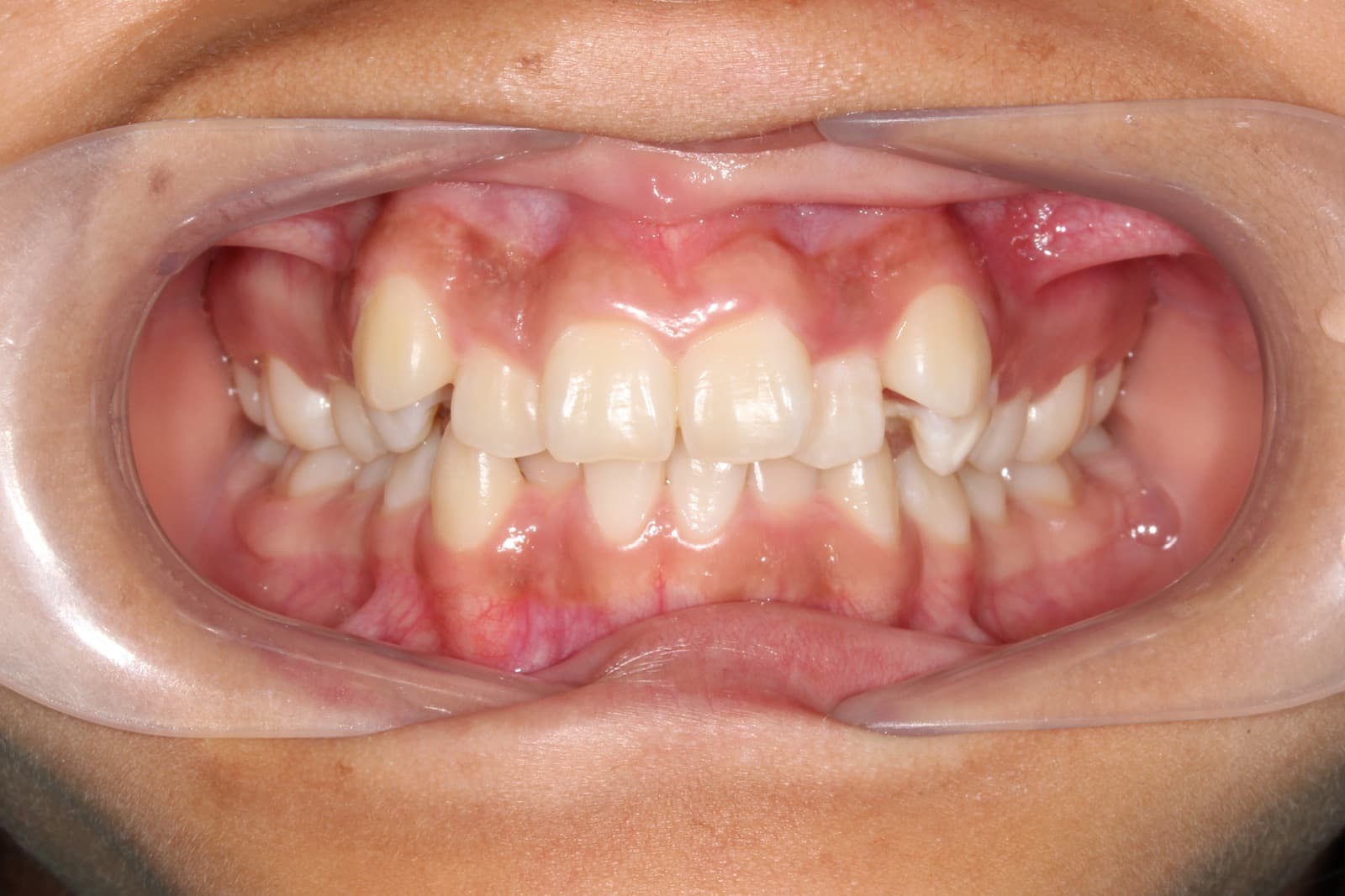 Susan — before orthodontic treatment at Linea
